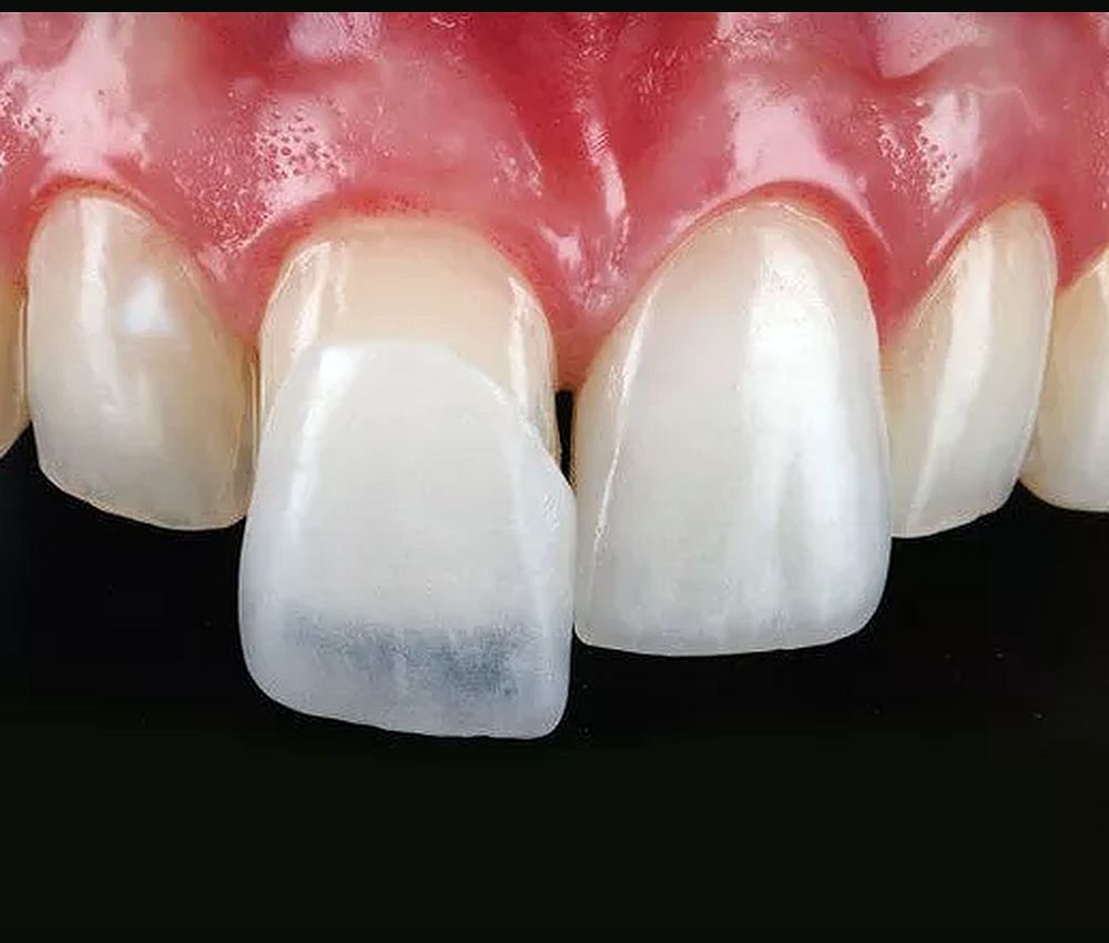Carillas dentales