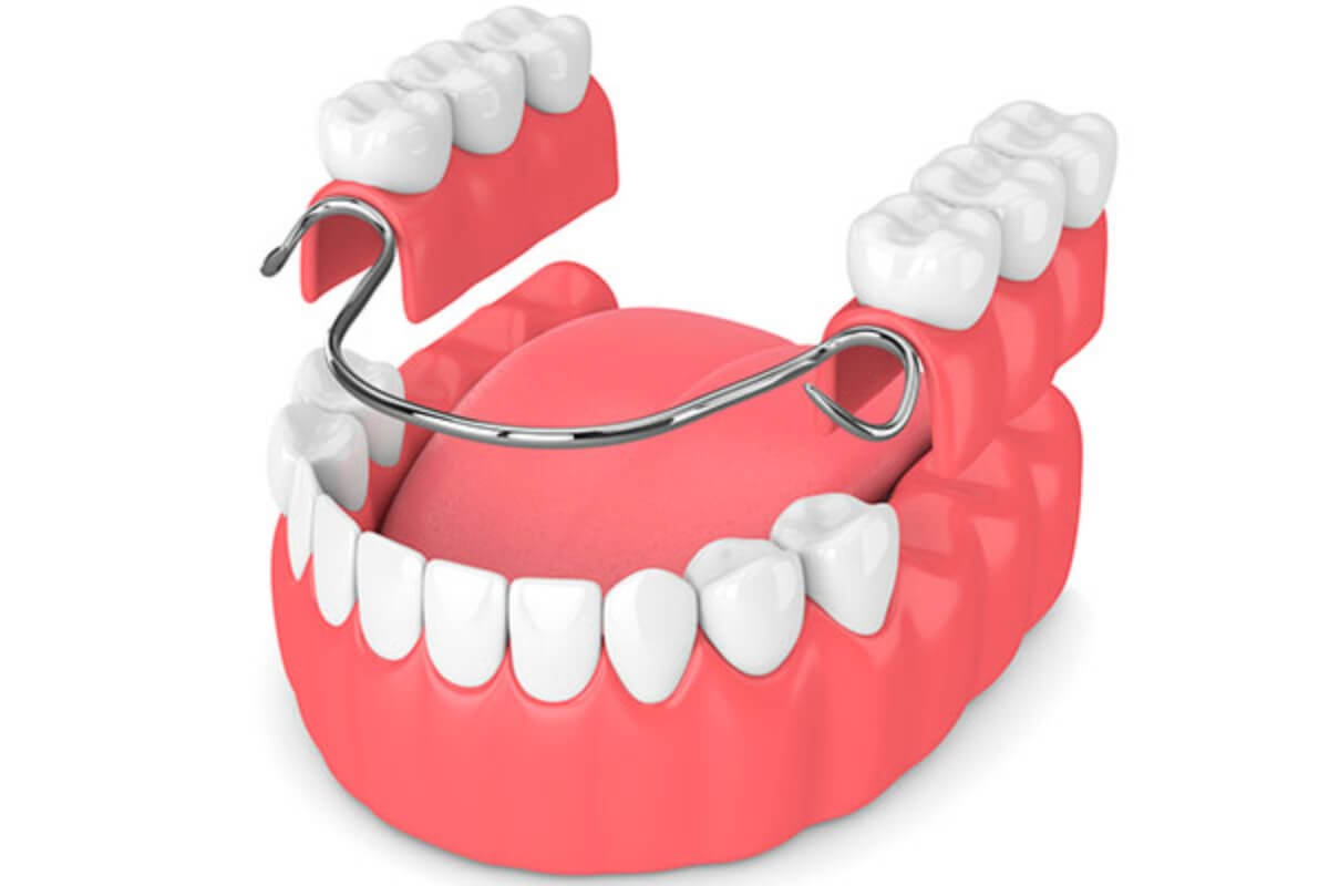 Prótesis dentales