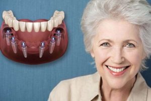 Implante Dental