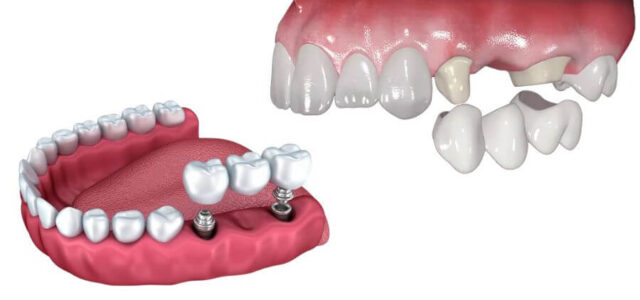 Puentes dentales