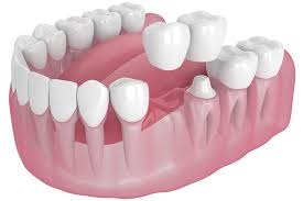 Implantes dentales